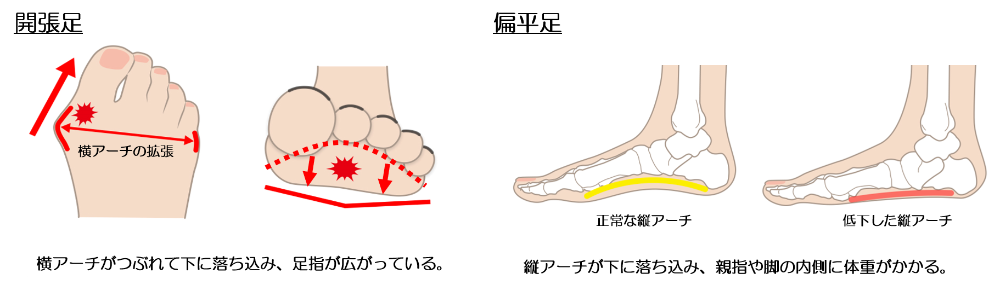 外反母趾に関係する「開張足」と「偏平足」